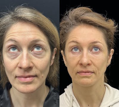 Lower Blepharoplasty Before & After Gallery - Patient 149032 - Image 2