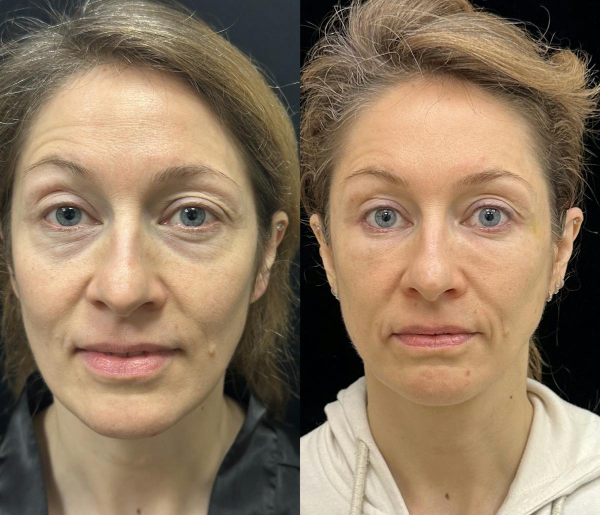 Lower Blepharoplasty Before & After Gallery - Patient 149032 - Image 1