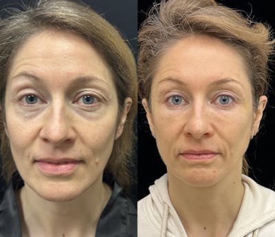 Lower Blepharoplasty Before & After Gallery - Patient 149032 - Image 1