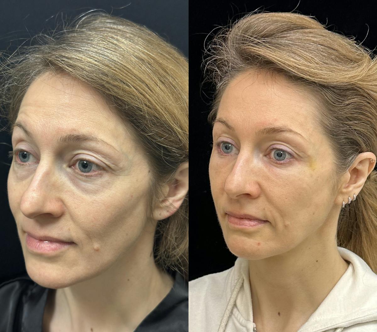 Lower Blepharoplasty Before & After Gallery - Patient 149032 - Image 3