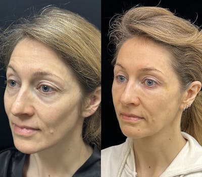 Lower Blepharoplasty Before & After Gallery - Patient 149032 - Image 3