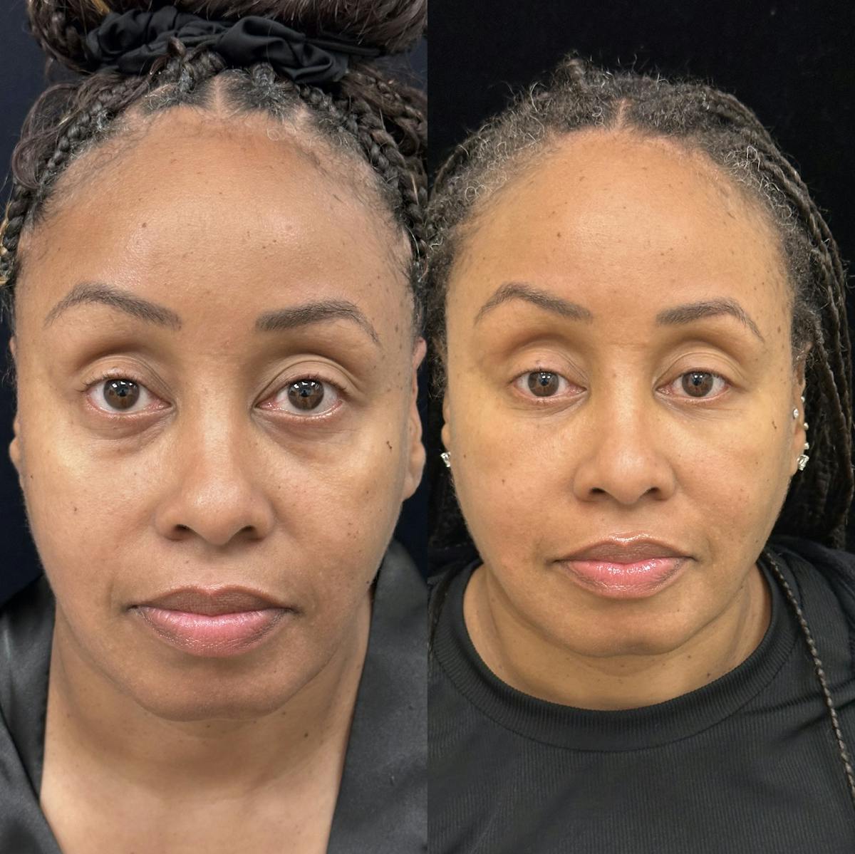 Lower Blepharoplasty Before & After Gallery - Patient 323690 - Image 1