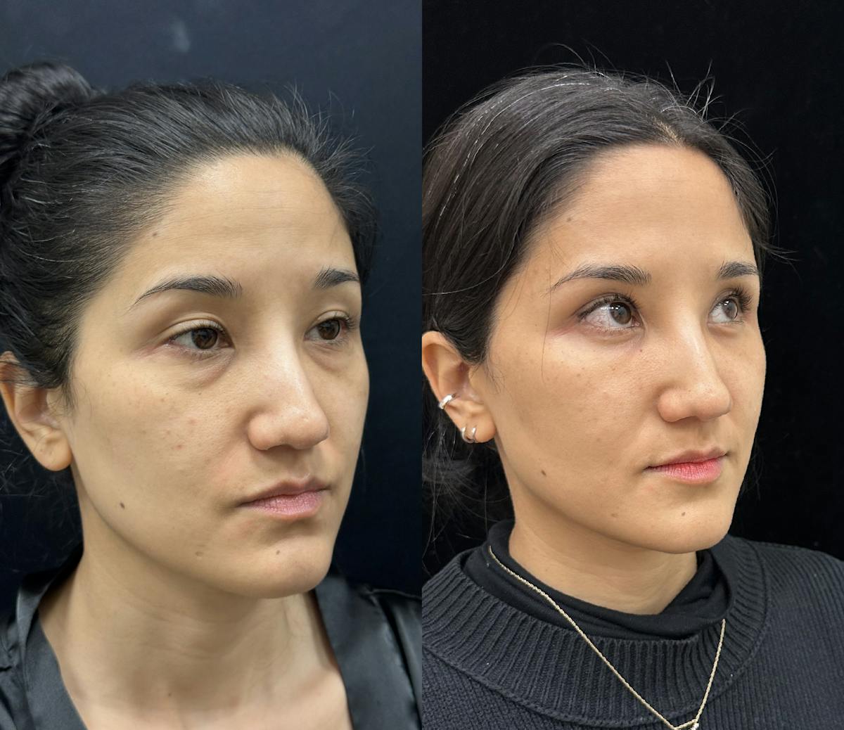 Lower Blepharoplasty Before & After Gallery - Patient 927956 - Image 2