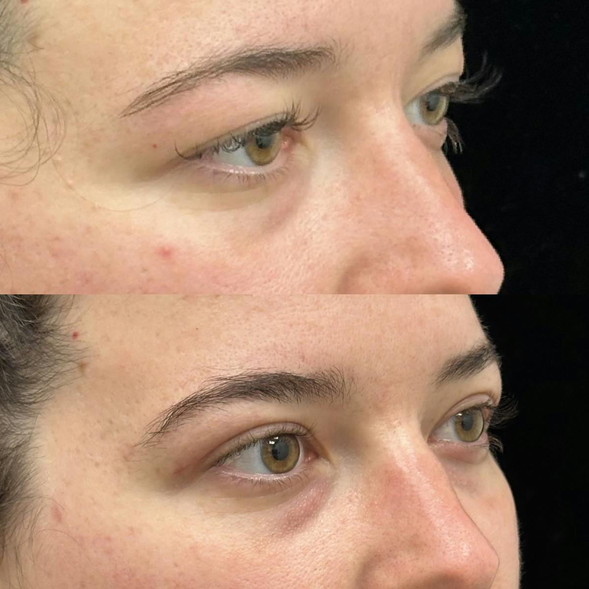  Upper Blepharoplasty Before & After Gallery - Patient 476578 - Image 2