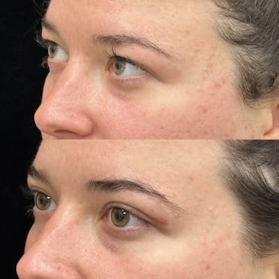 Upper Blepharoplasty Before & After Gallery - Patient 476578 - Image 3
