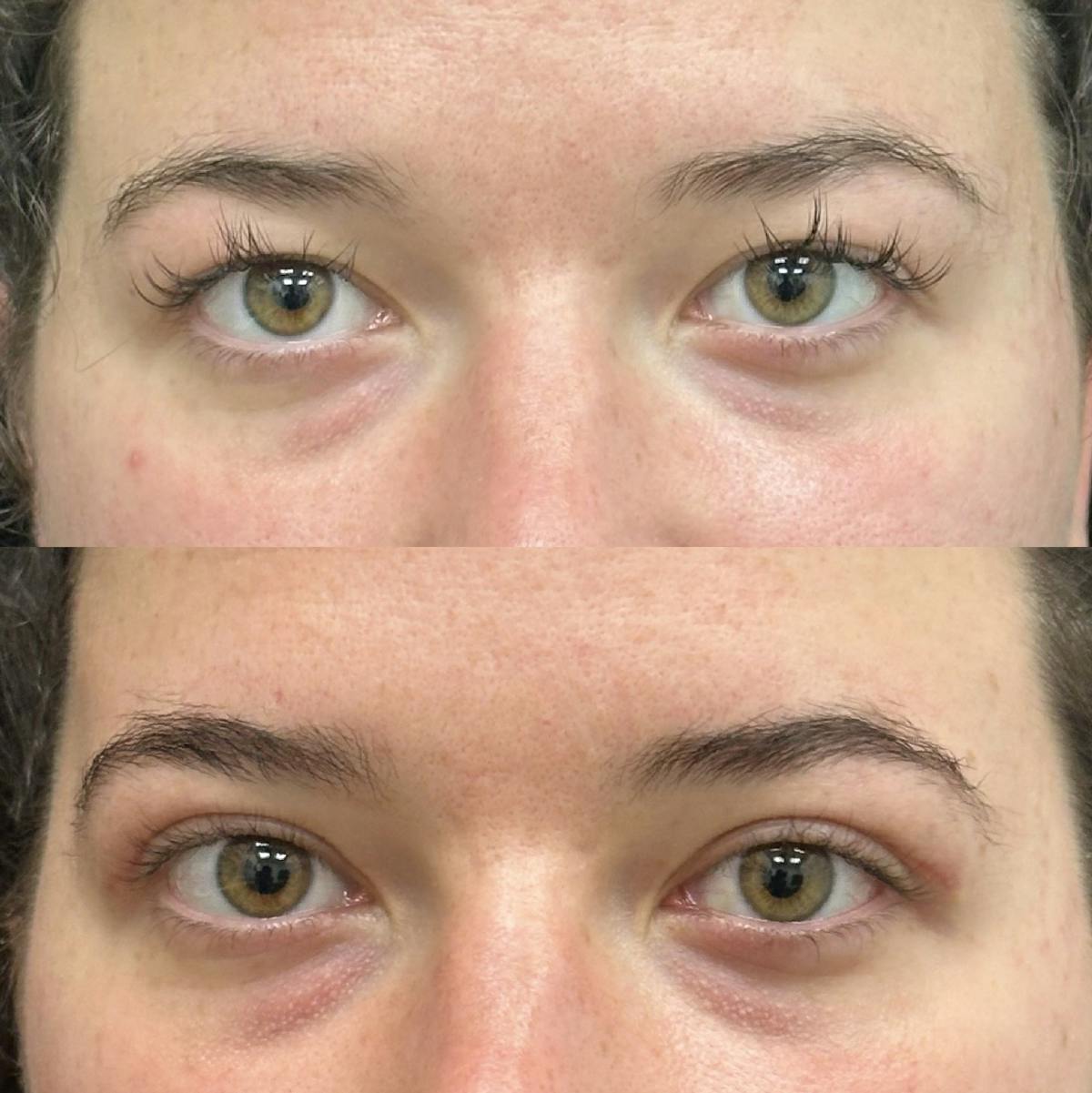  Upper Blepharoplasty Before & After Gallery - Patient 476578 - Image 1