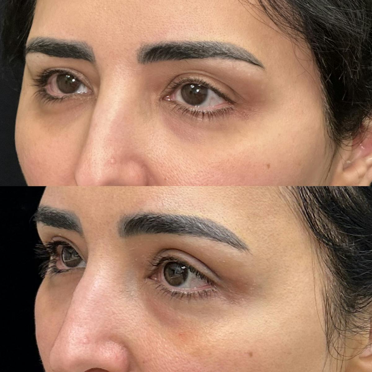  Upper Blepharoplasty Before & After Gallery - Patient 156262 - Image 2
