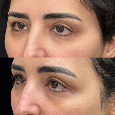 Upper Blepharoplasty Before & After Gallery - Patient 156262 - Image 2