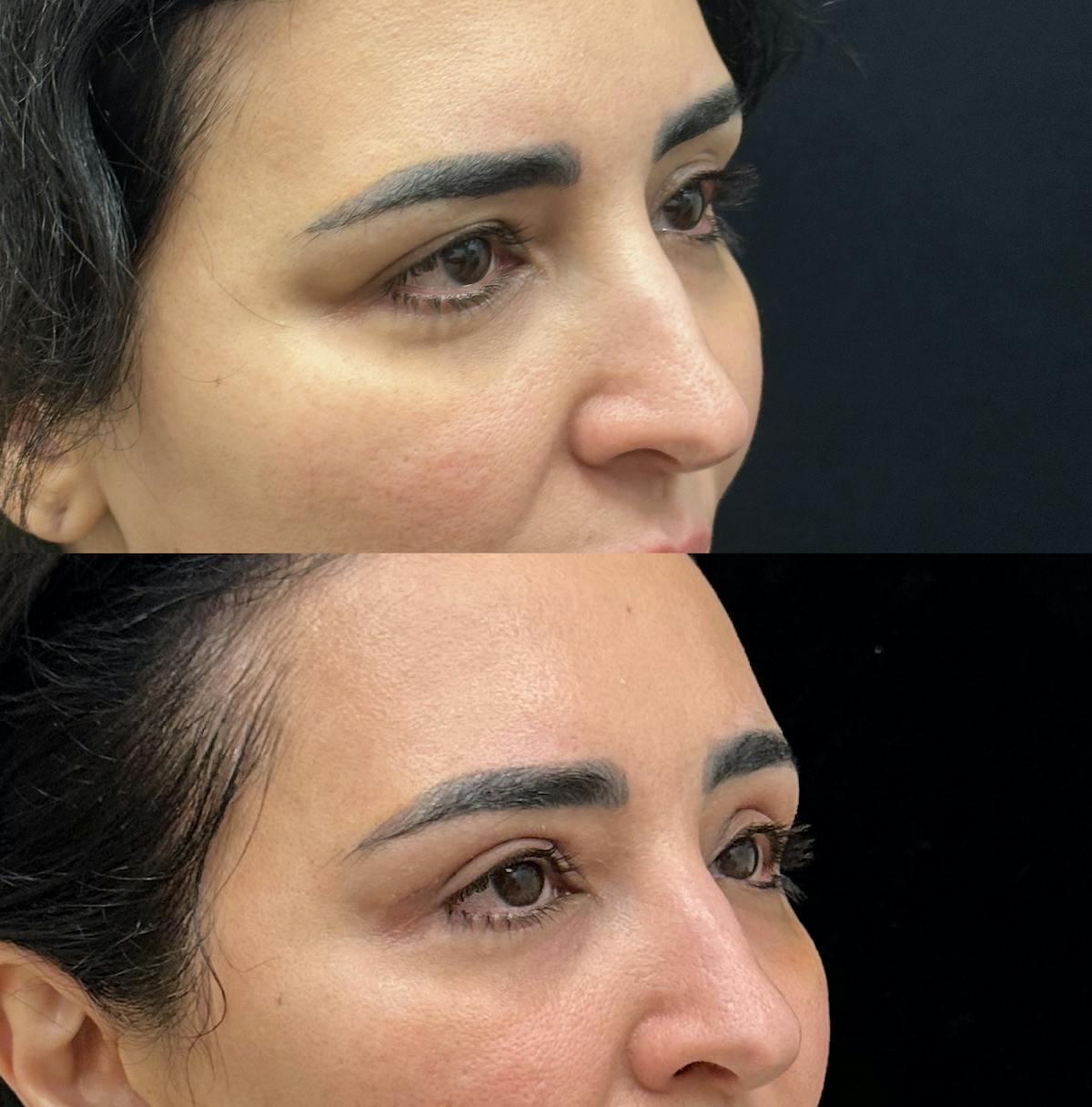  Upper Blepharoplasty Before & After Gallery - Patient 156262 - Image 3