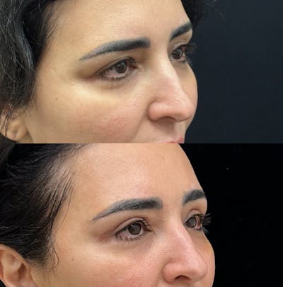 Upper Blepharoplasty Before & After Gallery - Patient 156262 - Image 3