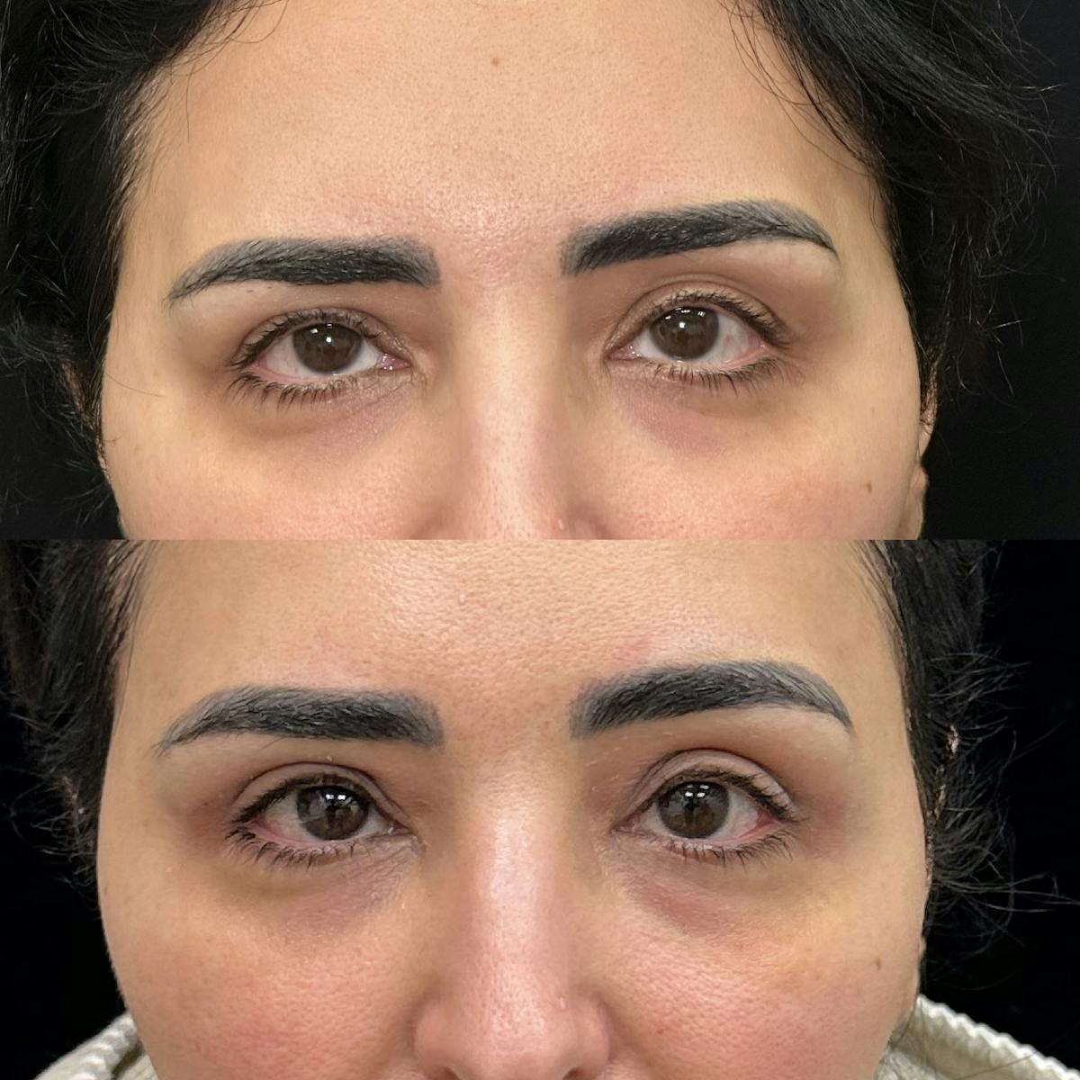  Upper Blepharoplasty Before & After Gallery - Patient 156262 - Image 1