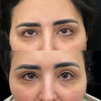 Upper Blepharoplasty Before & After Gallery - Patient 156262 - Image 1