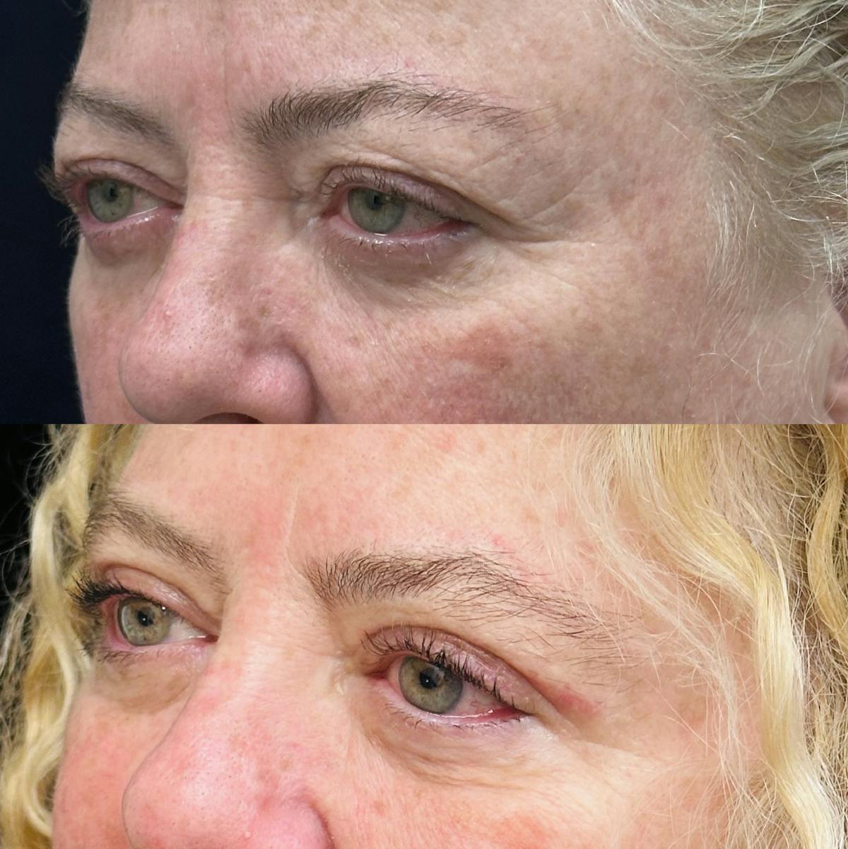  Upper Blepharoplasty Before & After Gallery - Patient 194747 - Image 3