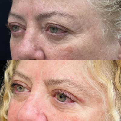 Upper Blepharoplasty Before & After Gallery - Patient 194747 - Image 3