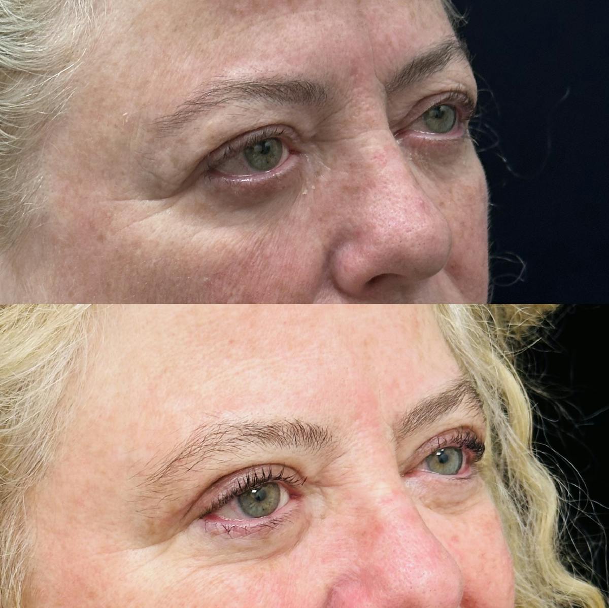 Upper Blepharoplasty Before & After Gallery - Patient 194747 - Image 2