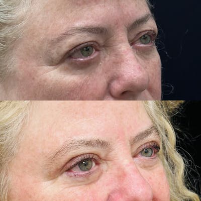 Upper Blepharoplasty Before & After Gallery - Patient 194747 - Image 2