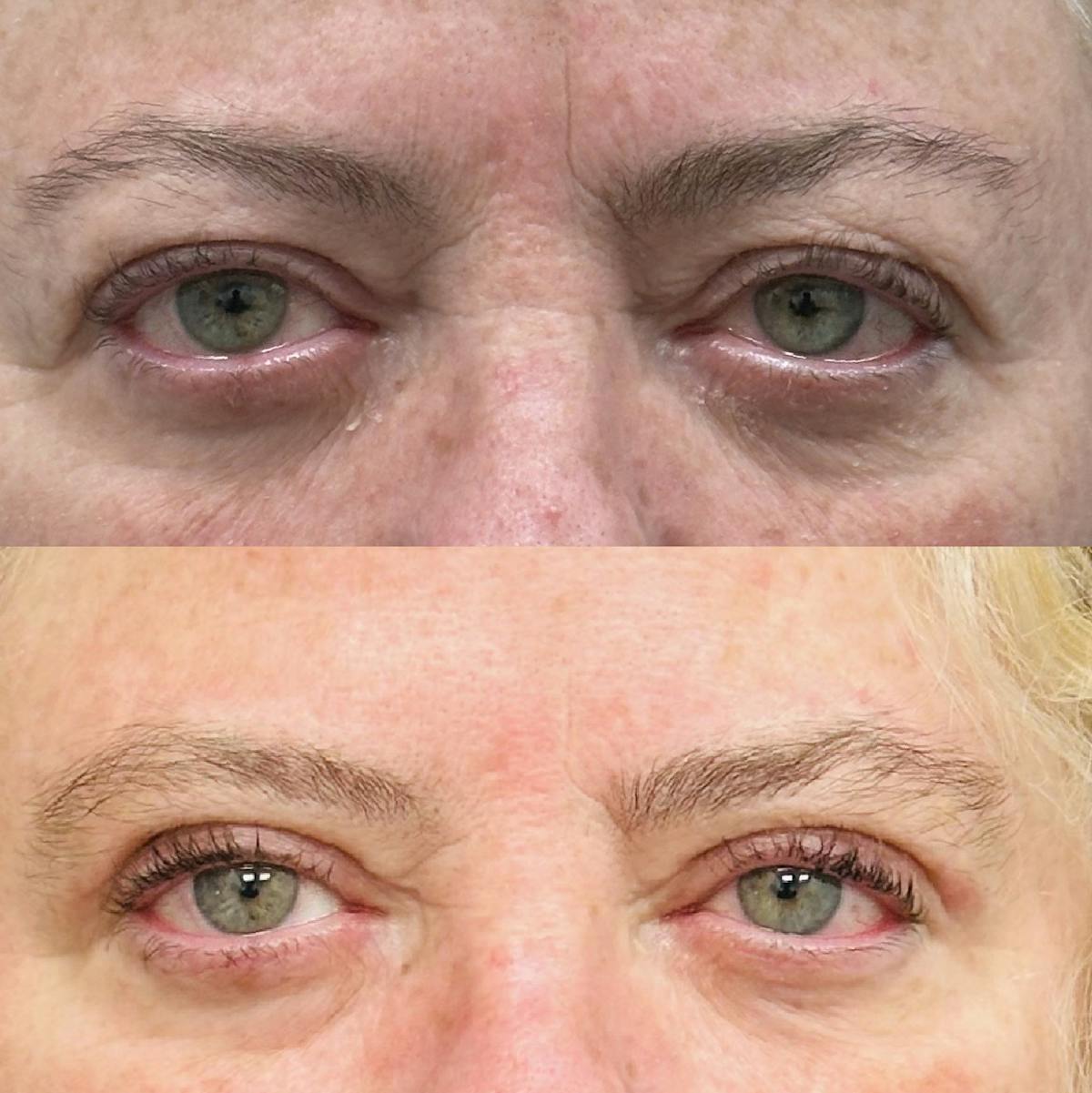  Upper Blepharoplasty Before & After Gallery - Patient 194747 - Image 1