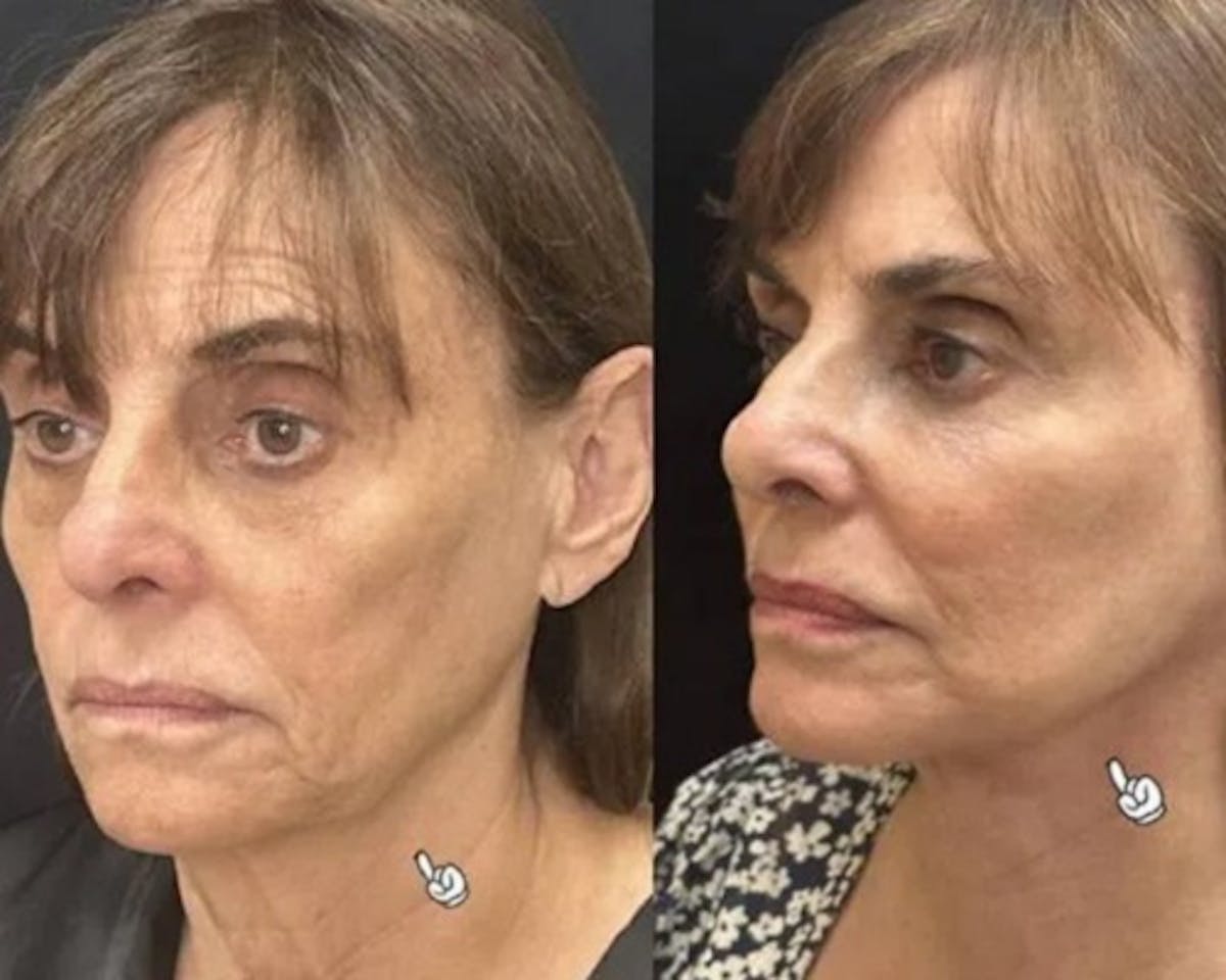 Deep Plane Facelift Before & After Gallery - Patient 341020 - Image 4