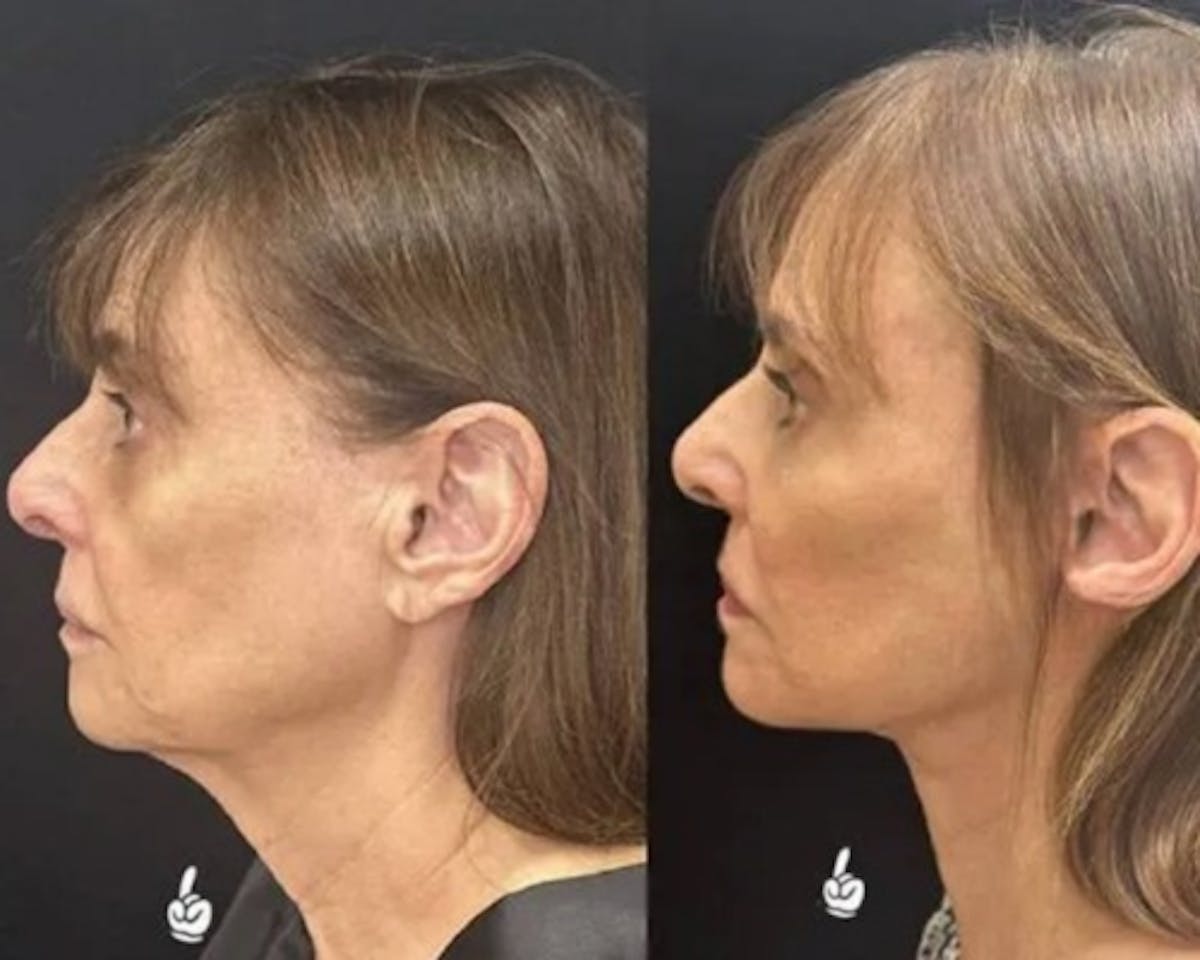 Deep Plane Facelift Before & After Gallery - Patient 341020 - Image 3