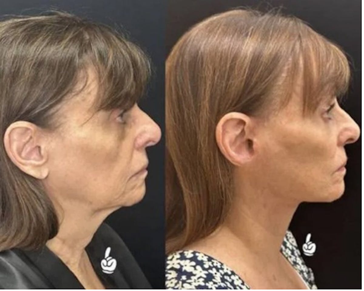 Deep Plane Facelift Before & After Gallery - Patient 341020 - Image 1