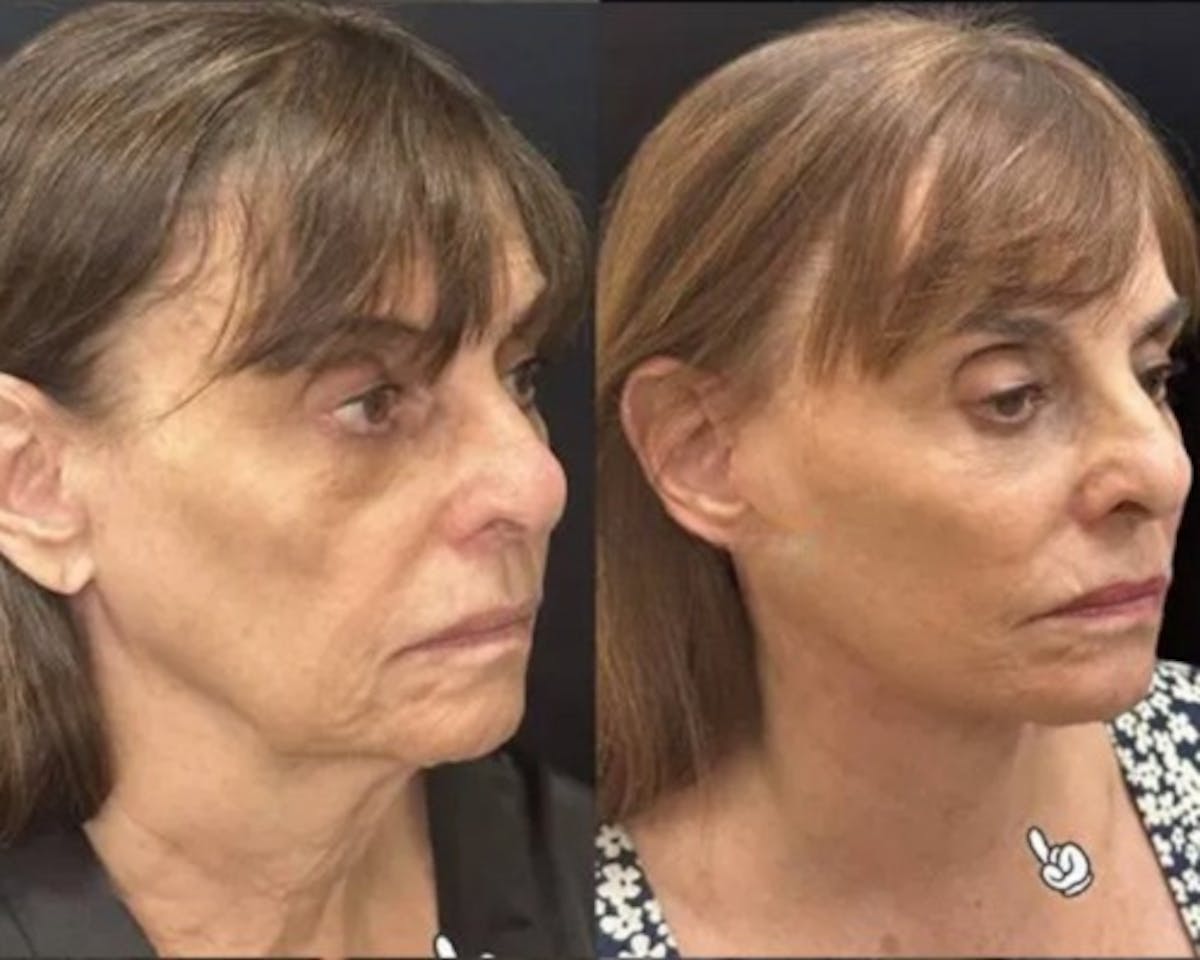 Deep Plane Facelift Before & After Gallery - Patient 341020 - Image 2