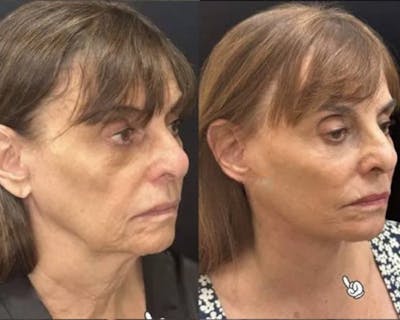Deep Plane Facelift Before & After Gallery - Patient 341020 - Image 2