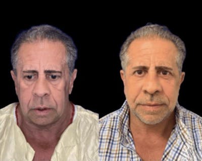 Deep Plane Facelift Before & After Gallery - Patient 258231 - Image 1