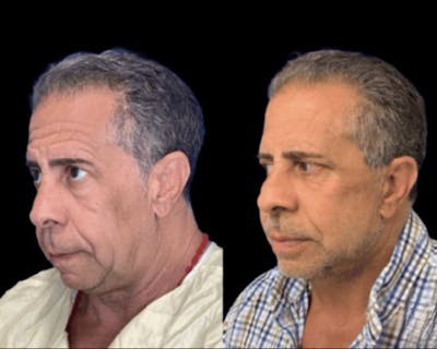 Deep Plane Facelift Before & After Gallery - Patient 258231 - Image 3