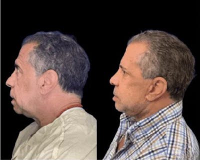 Deep Plane Facelift Before & After Gallery - Patient 258231 - Image 2