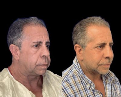 Deep Plane Facelift Before & After Gallery - Patient 258231 - Image 4