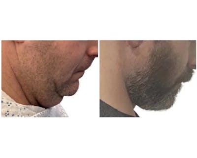 Male Facelift Before & After Gallery - Patient 340155 - Image 2