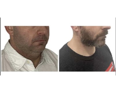 Male Facelift Before & After Gallery - Patient 340155 - Image 1