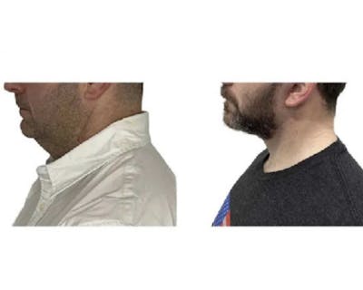 Male Facelift Before & After Gallery - Patient 340155 - Image 5