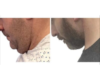 Male Facelift Before & After Gallery - Patient 340155 - Image 3