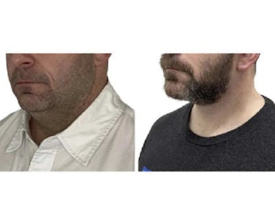 Male Facelift Before & After Gallery - Patient 340155 - Image 4
