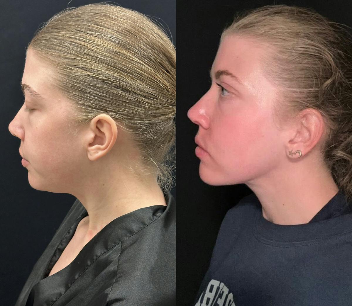 Chin & Neck Lipo Sculpting Before & After Gallery - Patient 233886 - Image 1