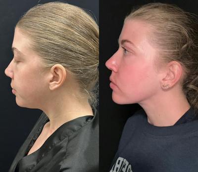 Chin & Neck Lipo Sculpting Before & After Gallery - Patient 233886 - Image 1