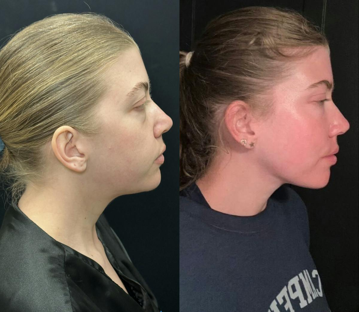 Chin & Neck Lipo Sculpting Before & After Gallery - Patient 233886 - Image 2