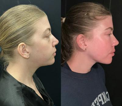 Chin & Neck Lipo Sculpting Before & After Gallery - Patient 233886 - Image 2