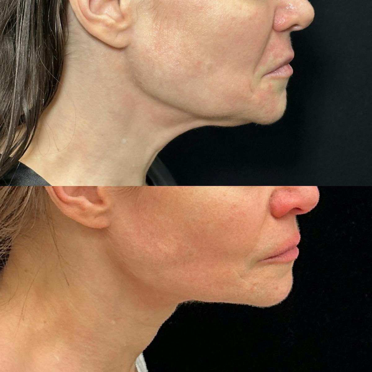 Necklift Before & After Gallery - Patient 149387 - Image 1