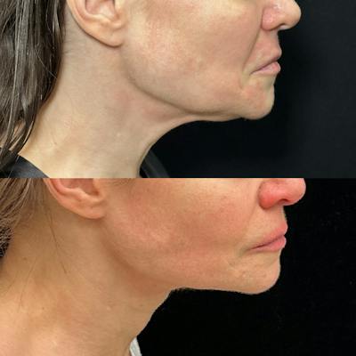 Necklift Before & After Gallery - Patient 149387 - Image 1
