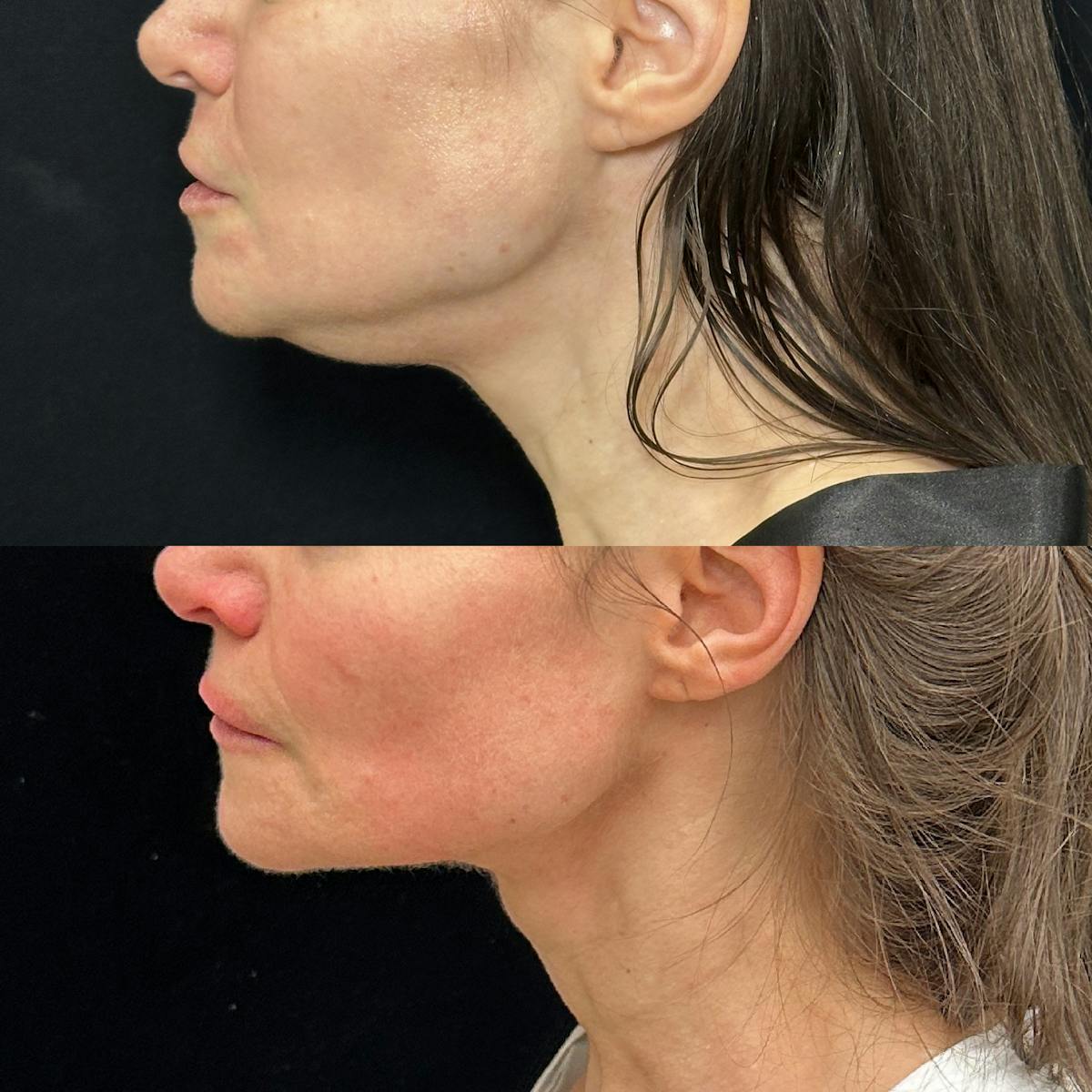 Necklift Before & After Gallery - Patient 149387 - Image 2