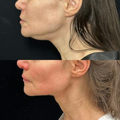 Necklift Before & After Gallery - Patient 149387 - Image 2