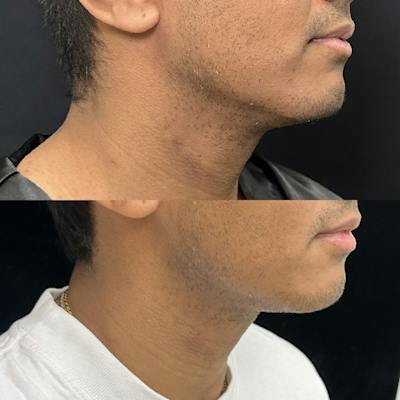 Necklift Before & After Gallery - Patient 487391 - Image 1