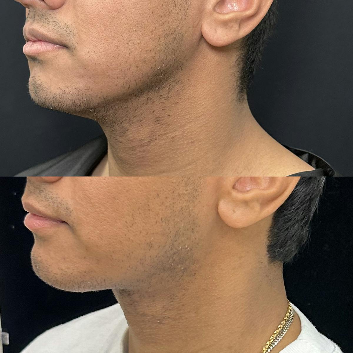 Necklift Before & After Gallery - Patient 487391 - Image 3