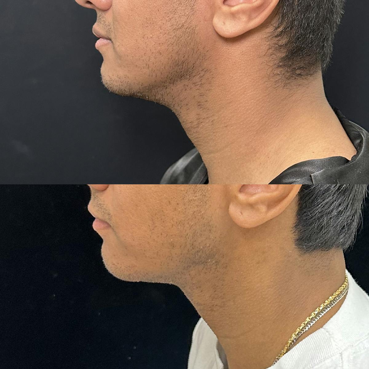 Necklift Before & After Gallery - Patient 487391 - Image 4