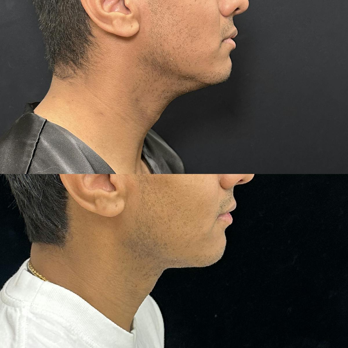 Necklift Before & After Gallery - Patient 487391 - Image 2