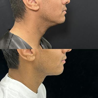 Necklift Before & After Gallery - Patient 487391 - Image 2