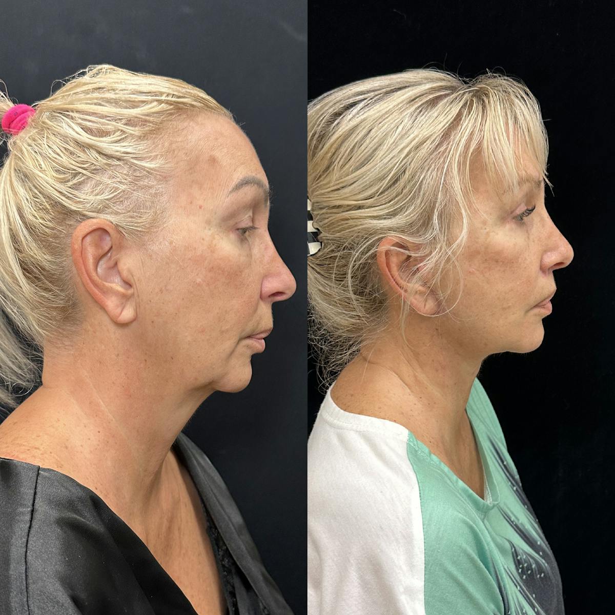 Deep Plane Facelift Before & After Gallery - Patient 299101 - Image 3