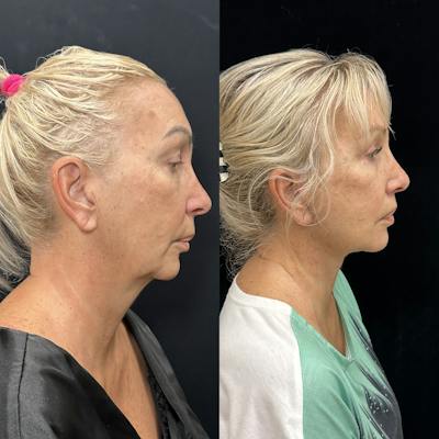 Deep Plane Facelift Before & After Gallery - Patient 299101 - Image 3